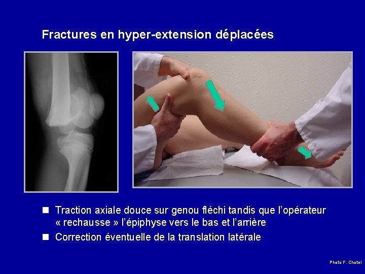 Fractures en hyper-extension déplacées n Traction axiale douce sur genou fléchi tandis que l’opérateur