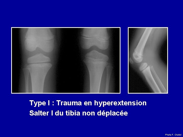 Type I : Trauma en hyperextension Salter I du tibia non déplacée Photo F.