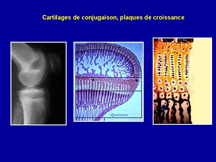 Cartilages de conjugaison, plaques de croissance 