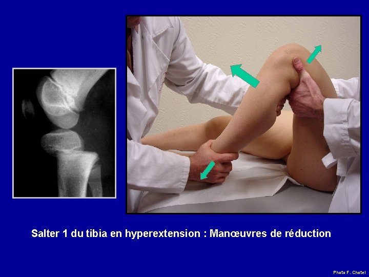 Salter 1 du tibia en hyperextension : Manœuvres de réduction Photo F. Chotel 