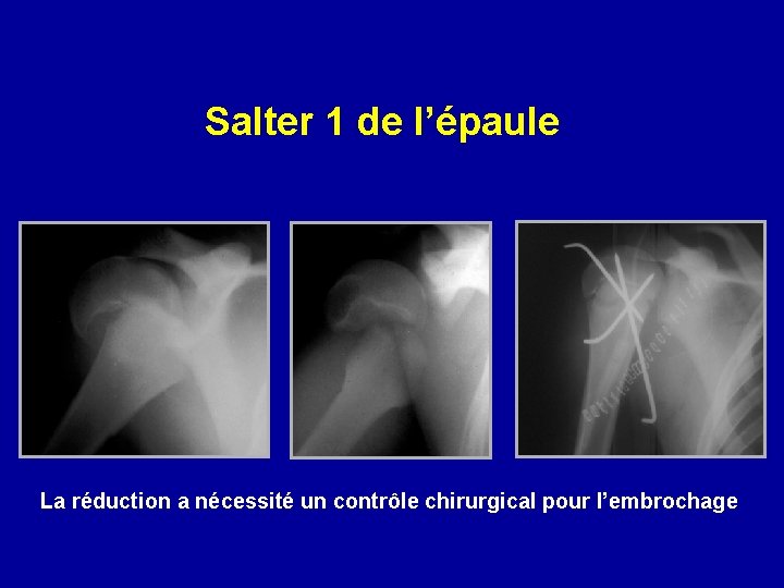 Salter 1 de l’épaule La réduction a nécessité un contrôle chirurgical pour l’embrochage 