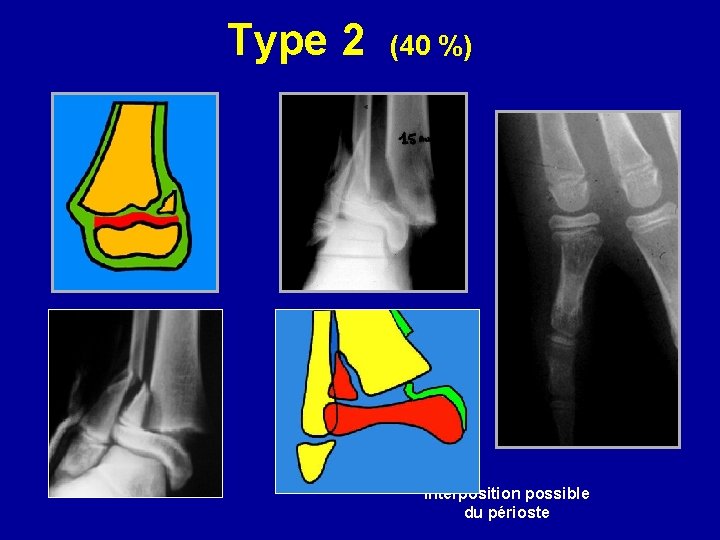 Type 2 (40 %) Interposition possible du périoste 