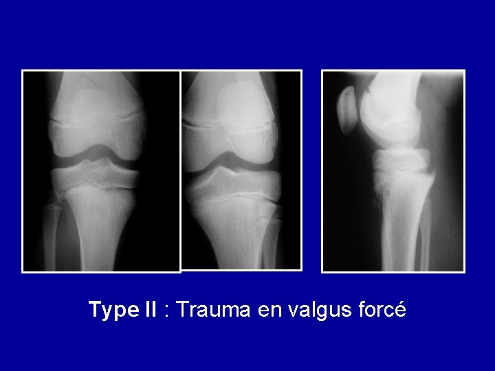 Type II : Trauma en valgus forcé 