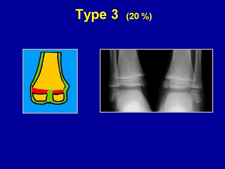 Type 3 (20 %) Type 3 (20 %)
