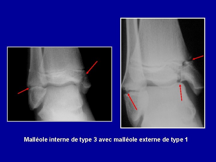 Malléole interne de type 3 avec malléole externe de type 1 