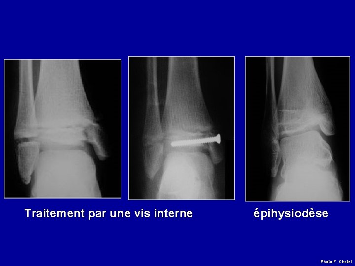 Traitement par une vis interne épihysiodèse Photo F. Chotel 