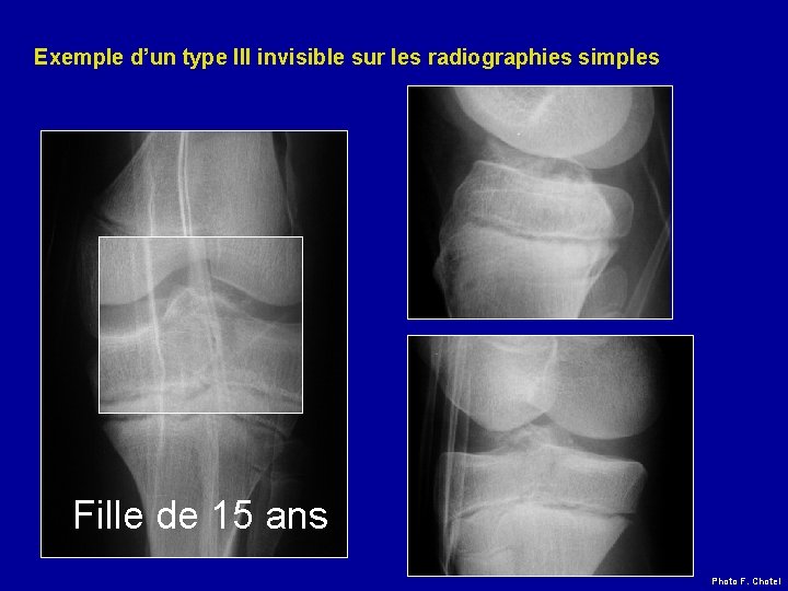 Exemple d’un type III invisible sur les radiographies simples Fille de 15 ans Photo