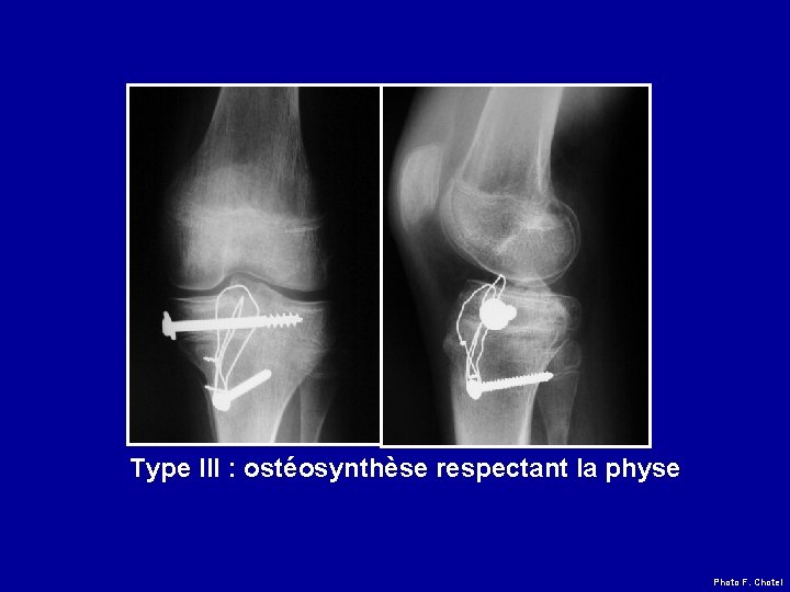 Type III : ostéosynthèse respectant la physe Photo F. Chotel Type III : ostéosynthèse respectant la physe Photo F. Chotel