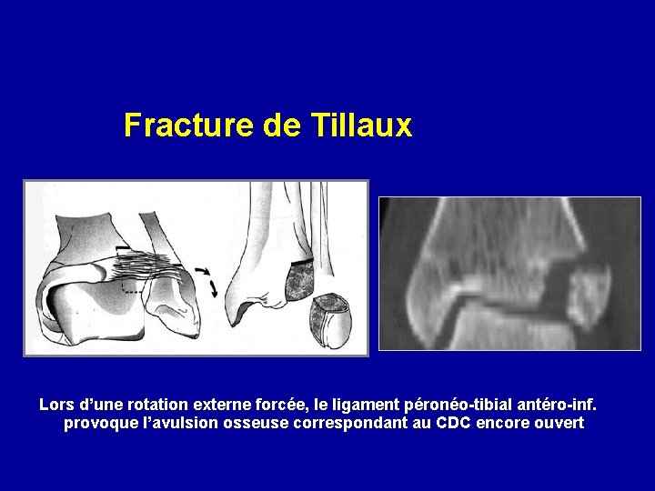 Fracture de Tillaux Lors d’une rotation externe forcée, le ligament péronéo-tibial antéro-inf. provoque l’avulsion