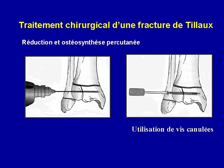 Traitement chirurgical d’une fracture de Tillaux Réduction et ostéosynthèse percutanée Utilisation de vis canulées