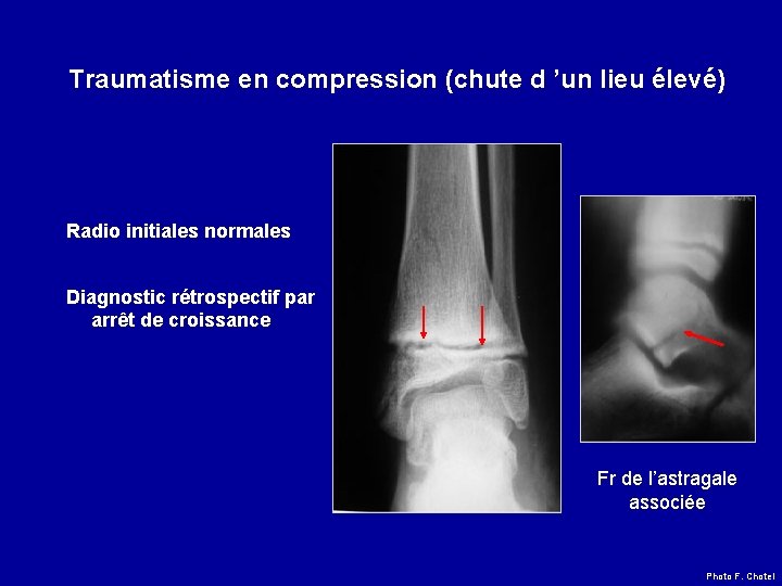 Traumatisme en compression (chute d ’un lieu élevé) Radio initiales normales Diagnostic rétrospectif par