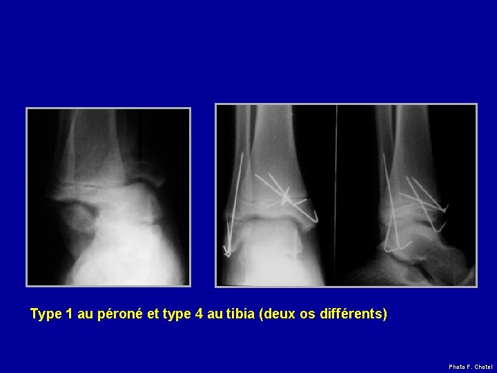 Type 1 au péroné et type 4 au tibia (deux os différents) Photo F.