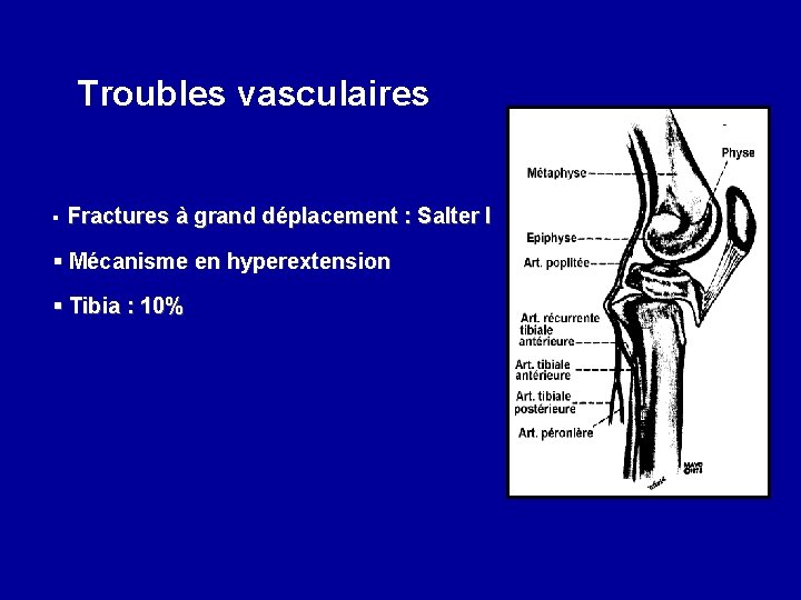 Troubles vasculaires § Fractures à grand déplacement : Salter I § Mécanisme en hyperextension