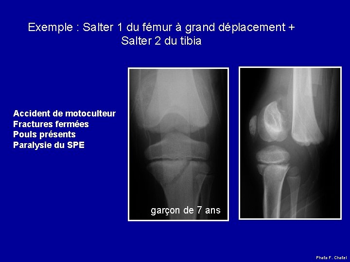 Exemple : Salter 1 du fémur à grand déplacement + Salter 2 du tibia Exemple : Salter 1 du fémur à grand déplacement + Salter 2 du tibia