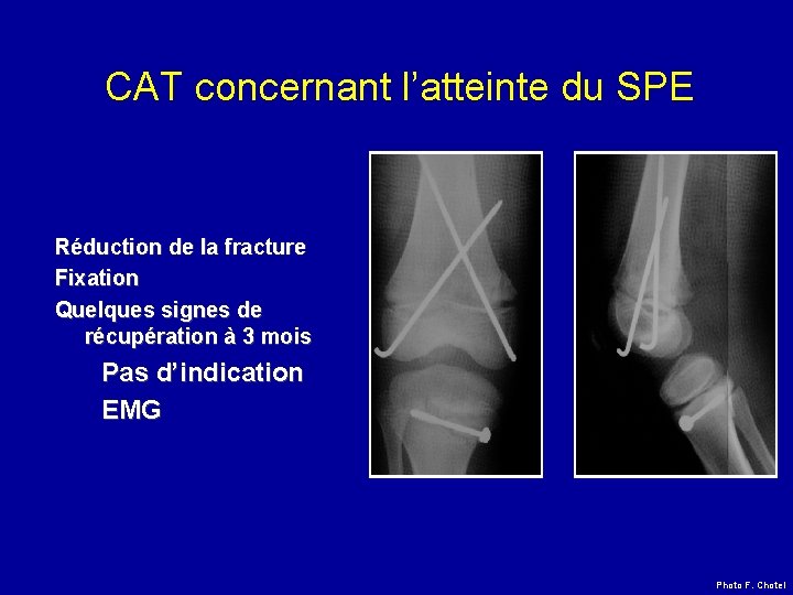 CAT concernant l’atteinte du SPE Réduction de la fracture Fixation Quelques signes de récupération