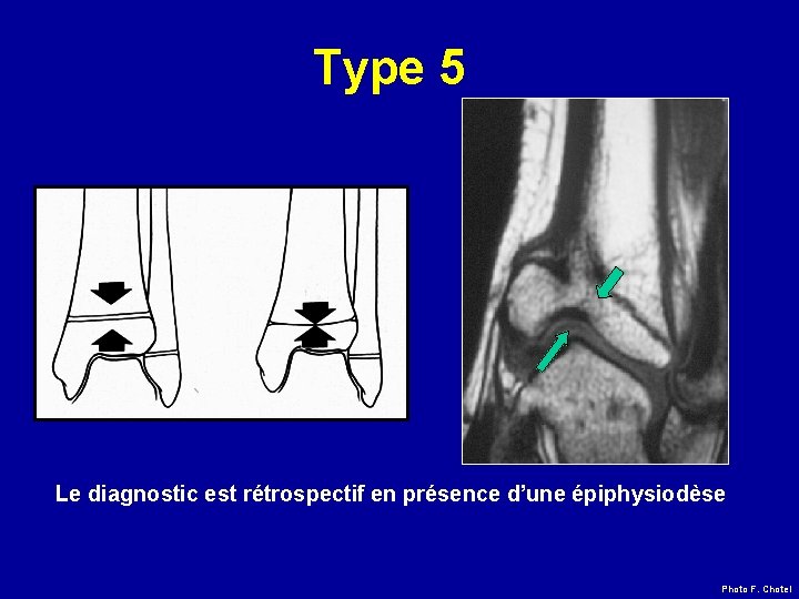 Type 5 Le diagnostic est rétrospectif en présence d’une épiphysiodèse Photo F. Chotel 