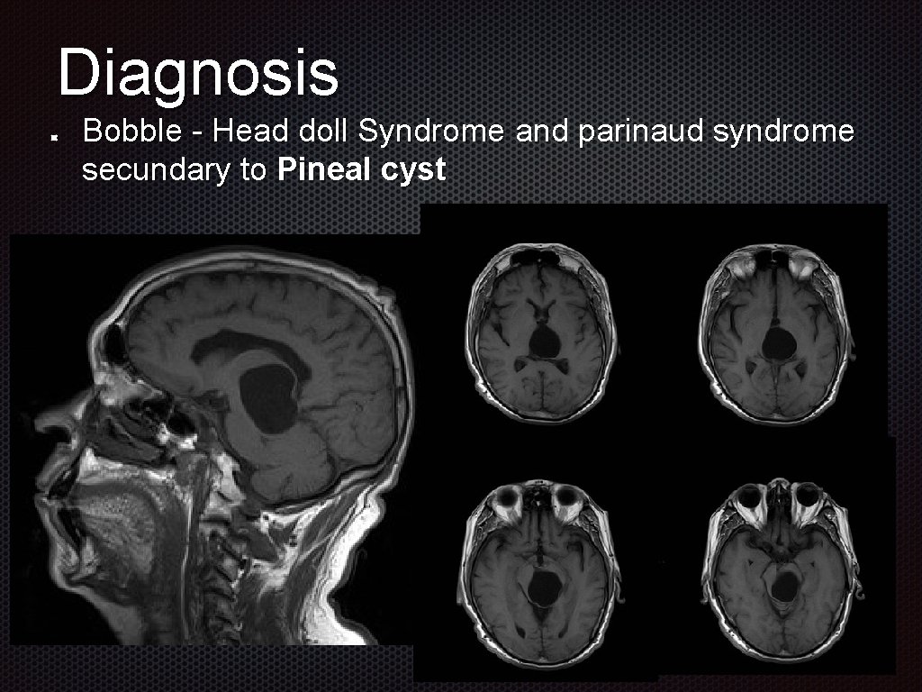 Diagnosis Bobble - Head doll Syndrome and parinaud syndrome secundary to Pineal cyst 