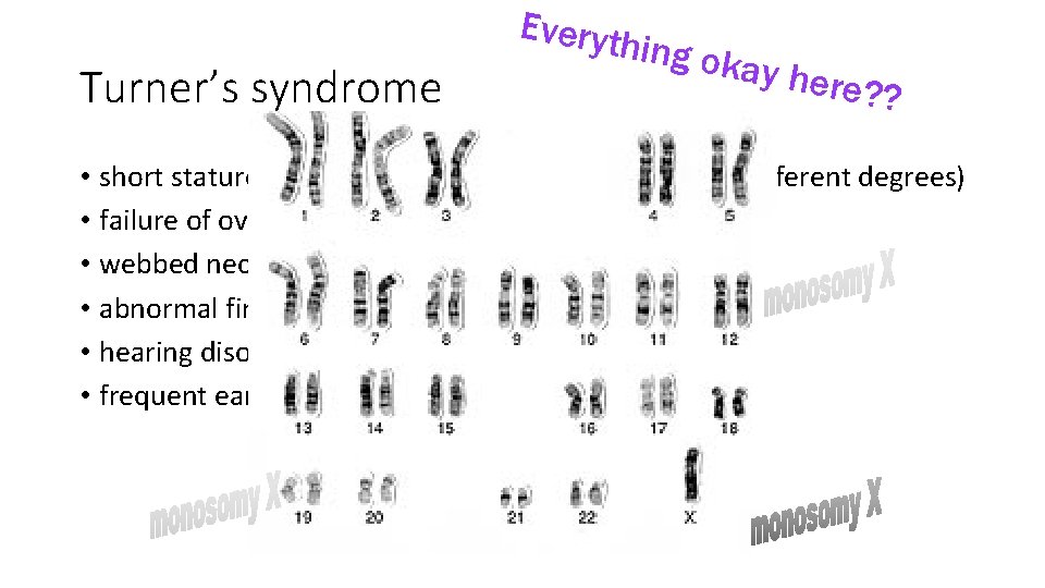 Turner’s syndrome Everyth ing ok ay her e? ? • short stature (affects almost