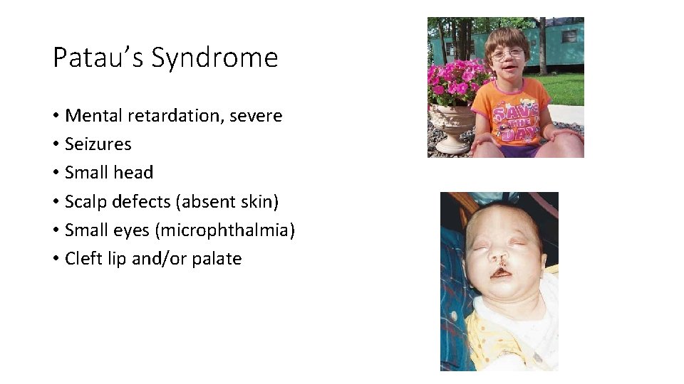Patau’s Syndrome • Mental retardation, severe • Seizures • Small head • Scalp defects