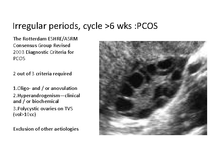 Irregular periods, cycle >6 wks : PCOS The Rotterdam ESHRE/ASRM Consensus Group Revised 2003