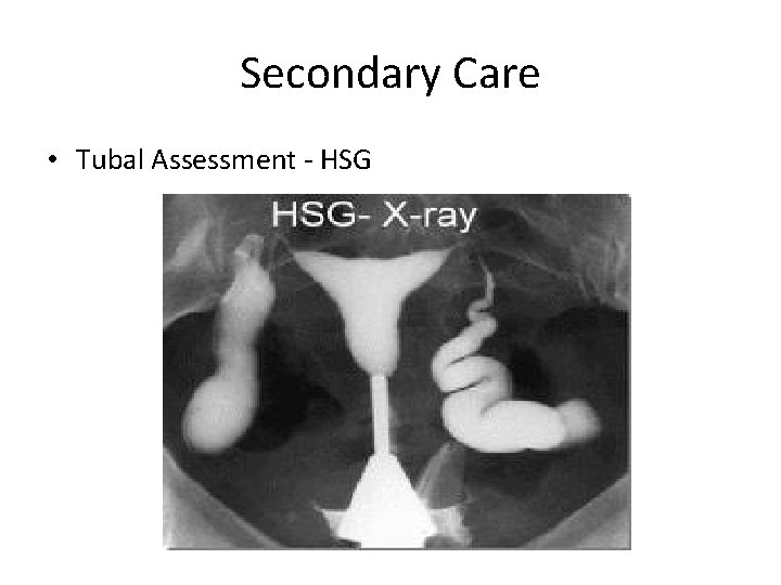Secondary Care • Tubal Assessment - HSG 