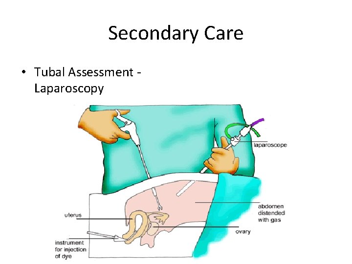 Secondary Care • Tubal Assessment Laparoscopy 