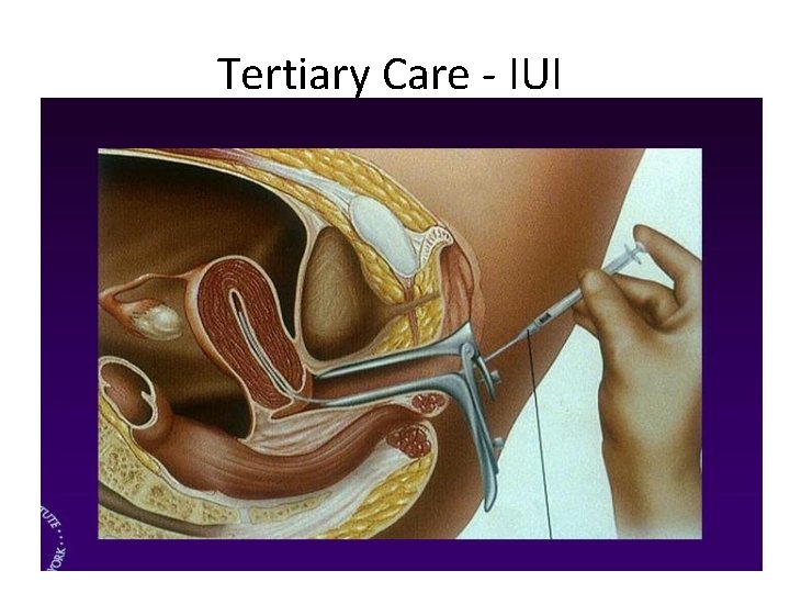 Tertiary Care - IUI 