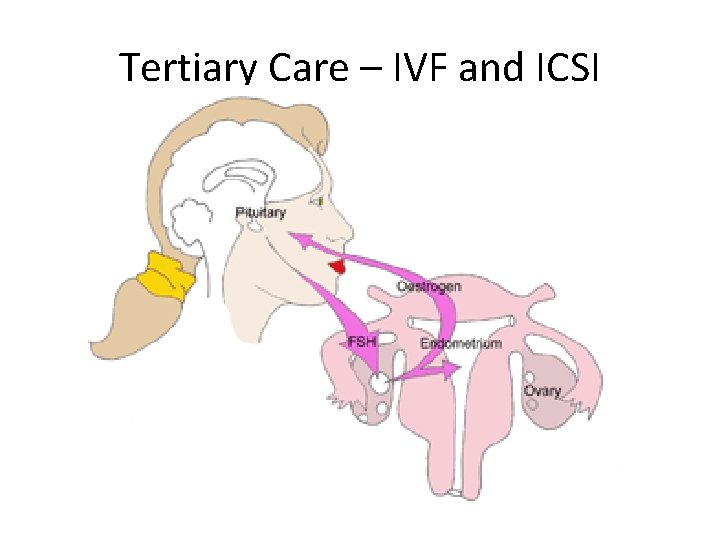 Tertiary Care – IVF and ICSI 