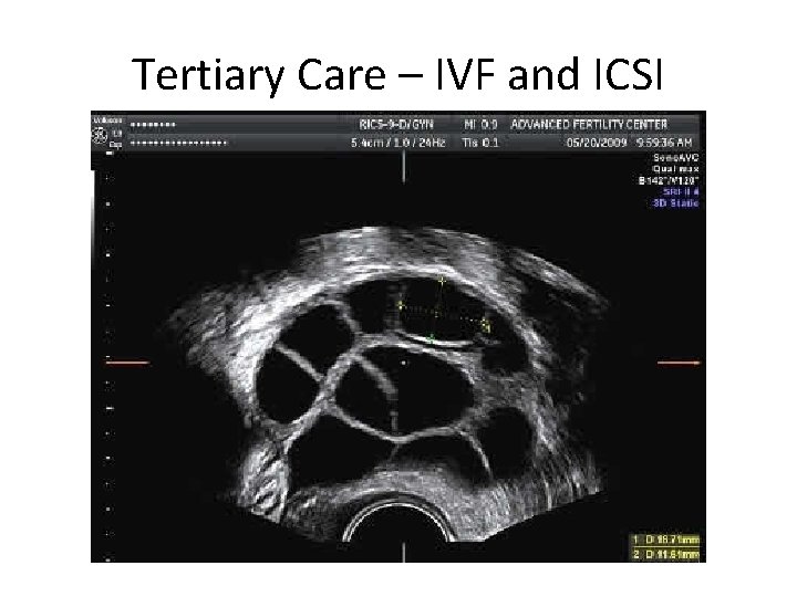 Tertiary Care – IVF and ICSI 