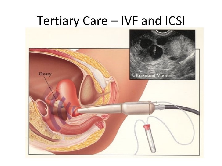 Tertiary Care – IVF and ICSI 