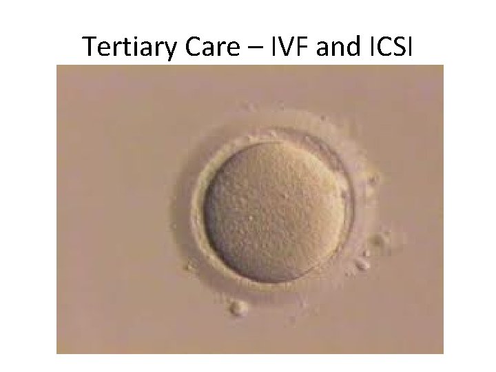 Tertiary Care – IVF and ICSI 