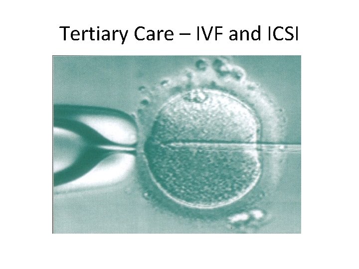 Tertiary Care – IVF and ICSI 