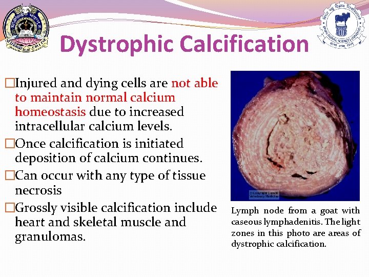 Dystrophic Calcification �Injured and dying cells are not able to maintain normal calcium homeostasis