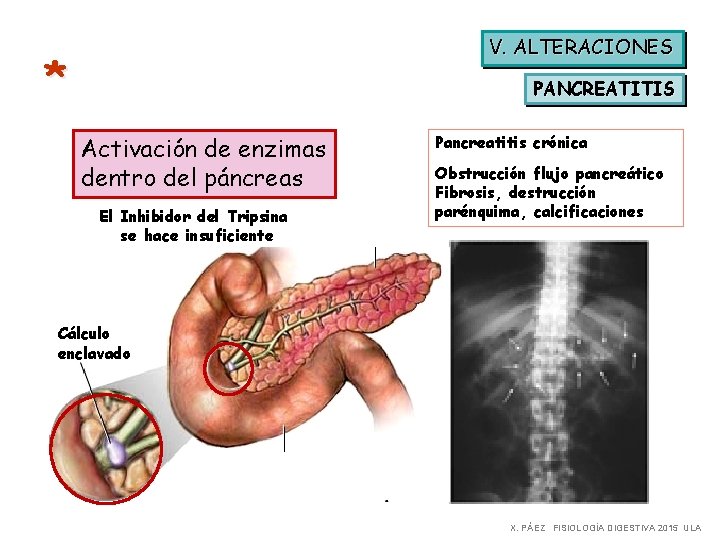 V. ALTERACIONES * PANCREATITIS Activación de enzimas dentro del páncreas El Inhibidor del Tripsina