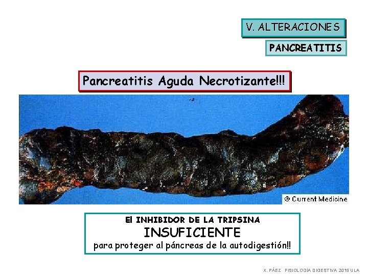 V. ALTERACIONES PANCREATITIS Pancreatitis Aguda Necrotizante!!! El INHIBIDOR DE LA TRIPSINA INSUFICIENTE para proteger