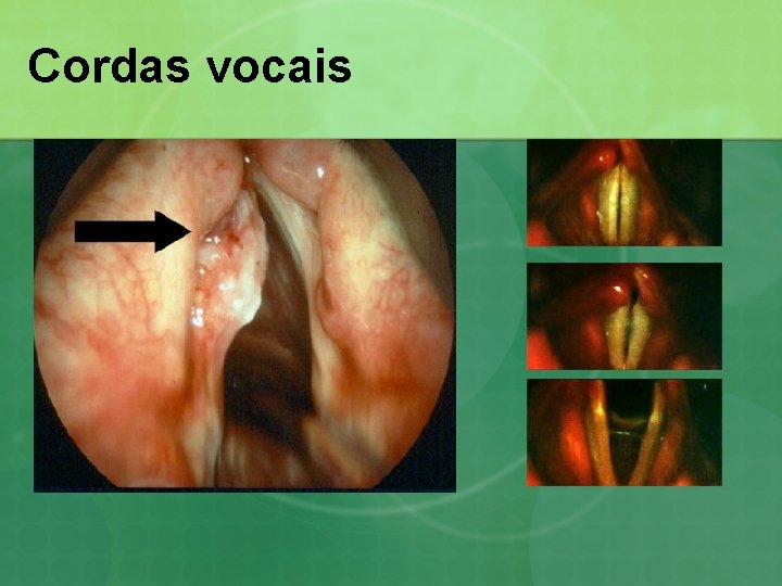 Cordas vocais 