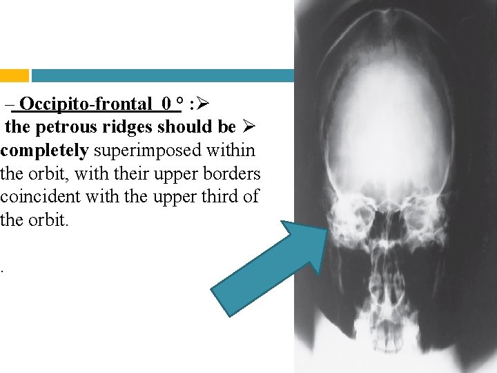 – Occipito-frontal 0 ° : Ø the petrous ridges should be Ø completely superimposed – Occipito-frontal 0 ° : Ø the petrous ridges should be Ø completely superimposed