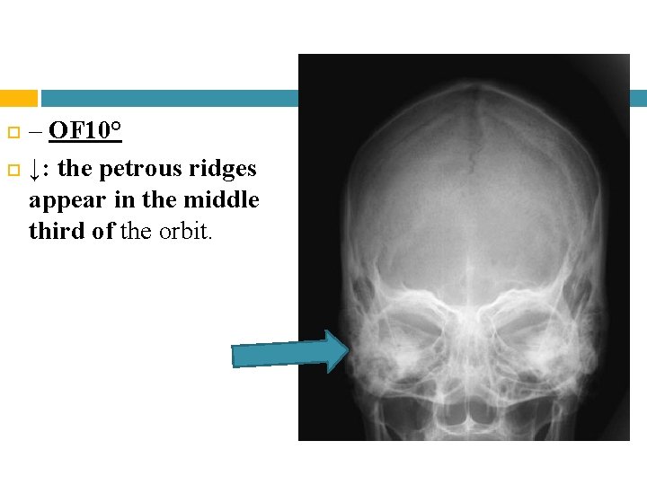 – OF 10° ↓: the petrous ridges appear in the middle third of – OF 10° ↓: the petrous ridges appear in the middle third of