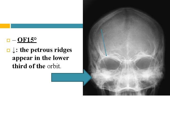  – OF 15° ↓: the petrous ridges appear in the lower third of