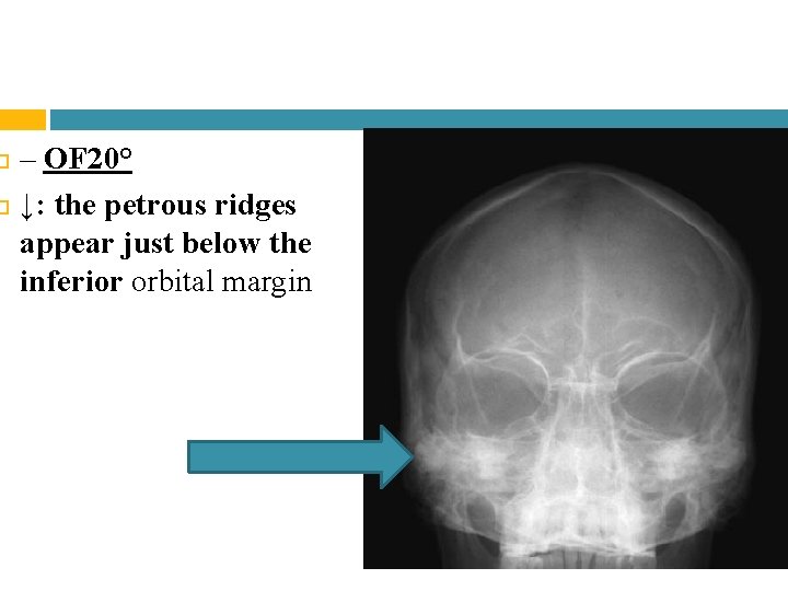 – OF 20° ↓: the petrous ridges appear just below the inferior orbital – OF 20° ↓: the petrous ridges appear just below the inferior orbital