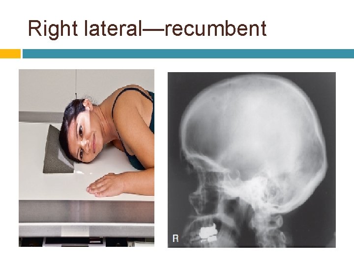 Right lateral—recumbent 