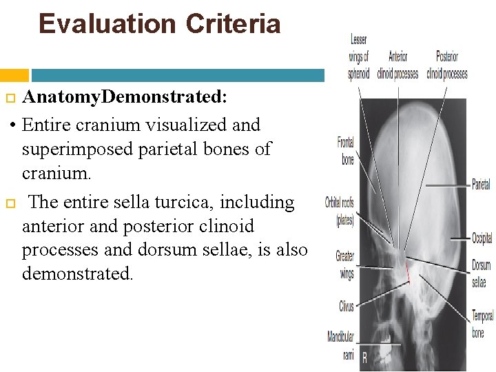 Evaluation Criteria Anatomy. Demonstrated: • Entire cranium visualized and superimposed parietal bones of cranium. Evaluation Criteria Anatomy. Demonstrated: • Entire cranium visualized and superimposed parietal bones of cranium.