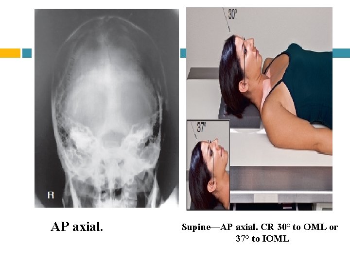 AP axial. Supine—AP axial. CR 30° to OML or 37° to IOML 