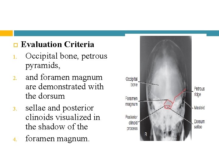 1. 2. 3. 4. Evaluation Criteria Occipital bone, petrous pyramids, and foramen magnum 1. 2. 3. 4. Evaluation Criteria Occipital bone, petrous pyramids, and foramen magnum