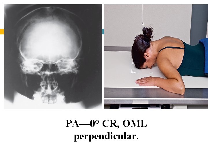 PA— 0° CR, OML perpendicular. 