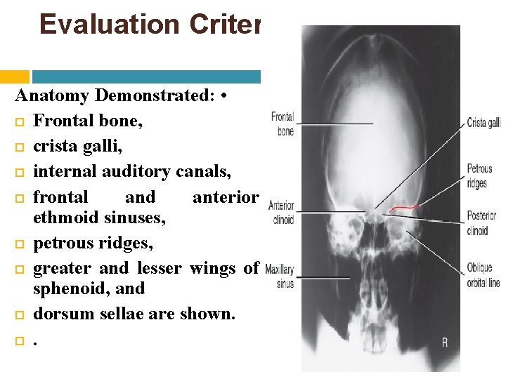 Evaluation Criteria Anatomy Demonstrated: • Frontal bone, crista galli, internal auditory canals, frontal and Evaluation Criteria Anatomy Demonstrated: • Frontal bone, crista galli, internal auditory canals, frontal and
