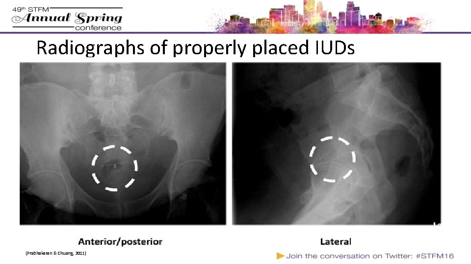 Radiographs of properly placed IUDs (Prabhakaran & Chuang, 2011) Radiographs of properly placed IUDs (Prabhakaran & Chuang, 2011)
