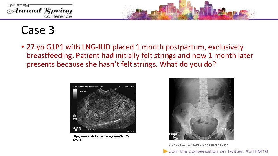 Case 3 • 27 yo G 1 P 1 with LNG-IUD placed 1 month Case 3 • 27 yo G 1 P 1 with LNG-IUD placed 1 month