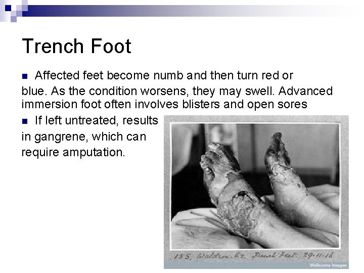 Trench Foot Affected feet become numb and then turn red or blue. As the