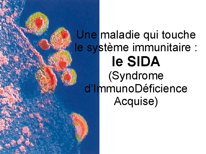 Une maladie qui touche le système immunitaire : le SIDA (Syndrome d’Immuno. Déficience Acquise)